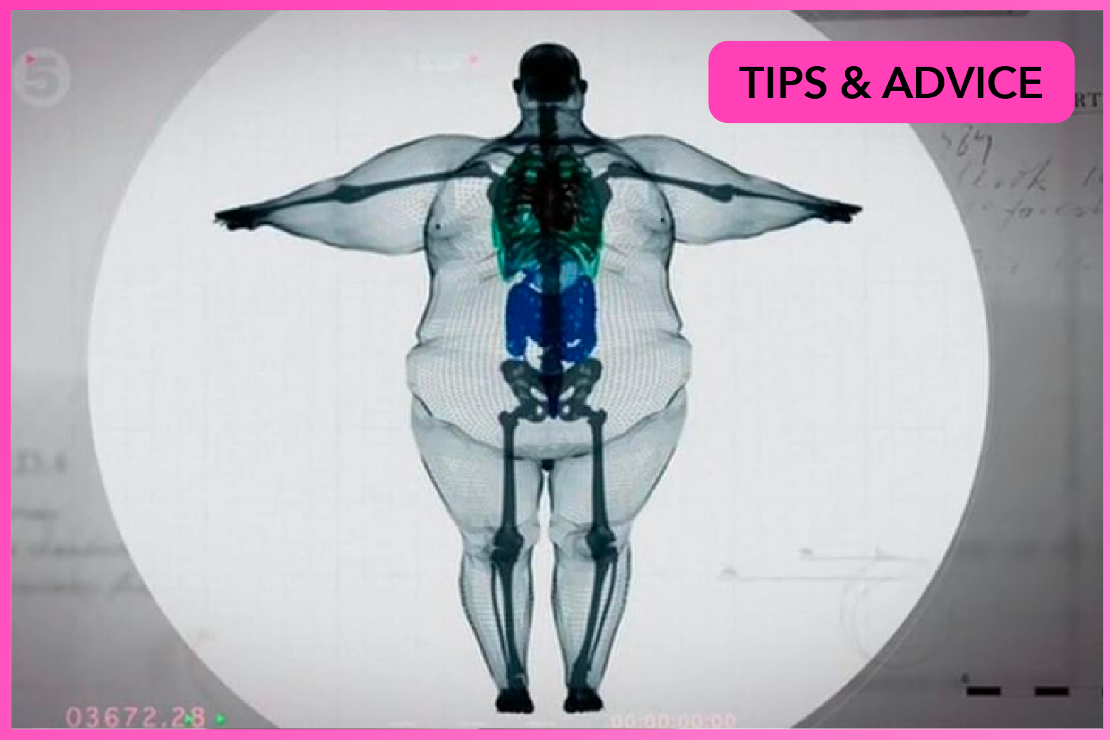 An x-ray of an obese person, showing body fat and bone structure
